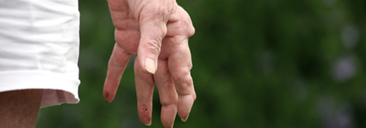 Chiropractic Port St. Lucie FL Arthritis Chiropractic Port St. Lucie FL Arthritis
